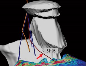 Fig. 2. The third sidetrack attempt was successful, using a solid expandable liner.